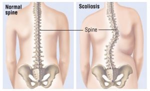 Scoliosis Spine 300x182