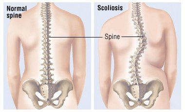 Scoliosis Spine