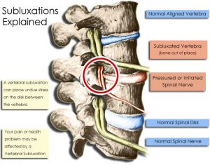 Subluxations Diagram Complete Chiropractic 300x235