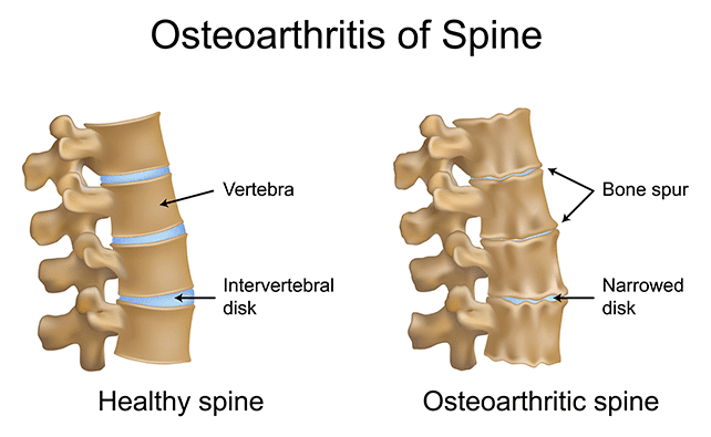 Image Blog An Ageing Population With Ageing Backs Osteoarthritis