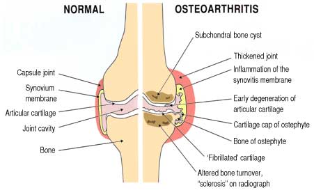 Normal Osteoarthritis