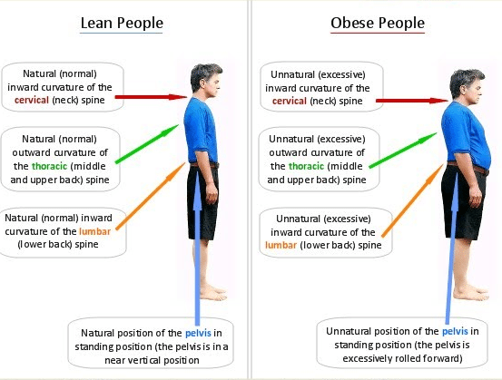Can Losing weight prevent back pain?