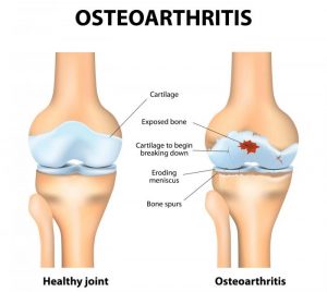 Diagram Showing Osteoarthritis Of The Knee 300x268