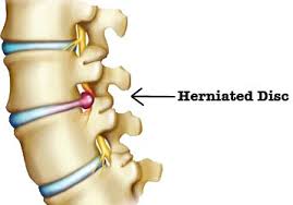 Herniated Disk