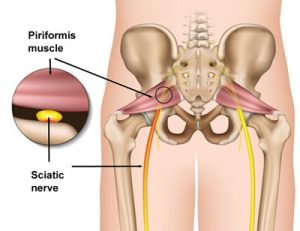 Piformis Sciatica 300x231