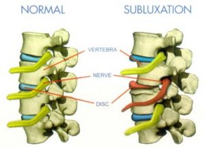 Subluxation Comparison 300x216