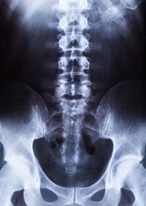 X Ray Spine And Pelvis 213x300