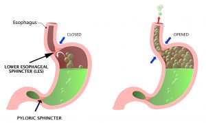 Heartburn Diagram 300x179
