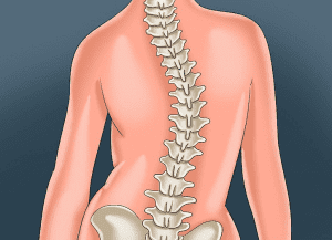 Scoliosis 300x217