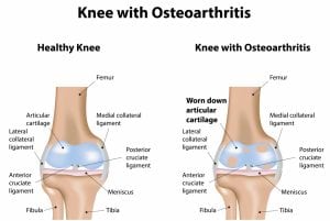 Treating Osteoarthritis with Glucosamine and Chondroitin OA Knee 300x201