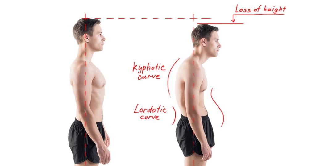 Treating Hyperkyphosis with Chiropractic Biophysics!