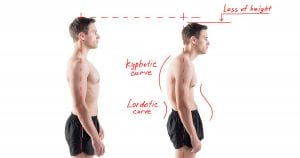 Treating Hyperkyphosis with Chiropractic Biophysics! Kyphosis 300x158