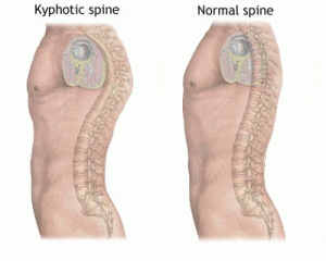Treating Hyperkyphosis with Chiropractic Biophysics! KyphoticSpine 300x240