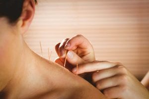 Accupuncture 300x200