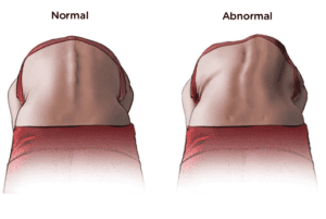 It’s scoliosis awareness month – don’t miss your FREE screening this weekend! Adams Test 300x201
