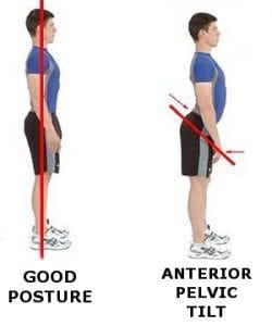 5 most common poor posture issues, and how to fix them! Fix Anterior Pelvic Tilt Poor Posture 250x300 250x300