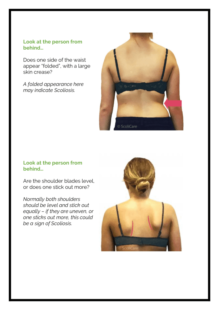 Complete Chiropractic Spot Scoli Handout 2 724x1024